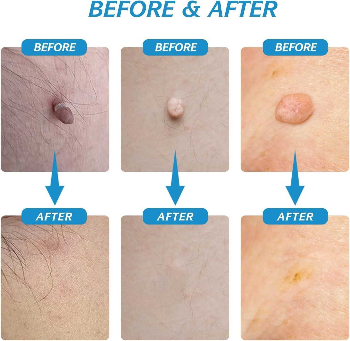 Before and after images showing effective skin tag removal using 2 in 1 Skin Tag Remover Kit painless treatment.