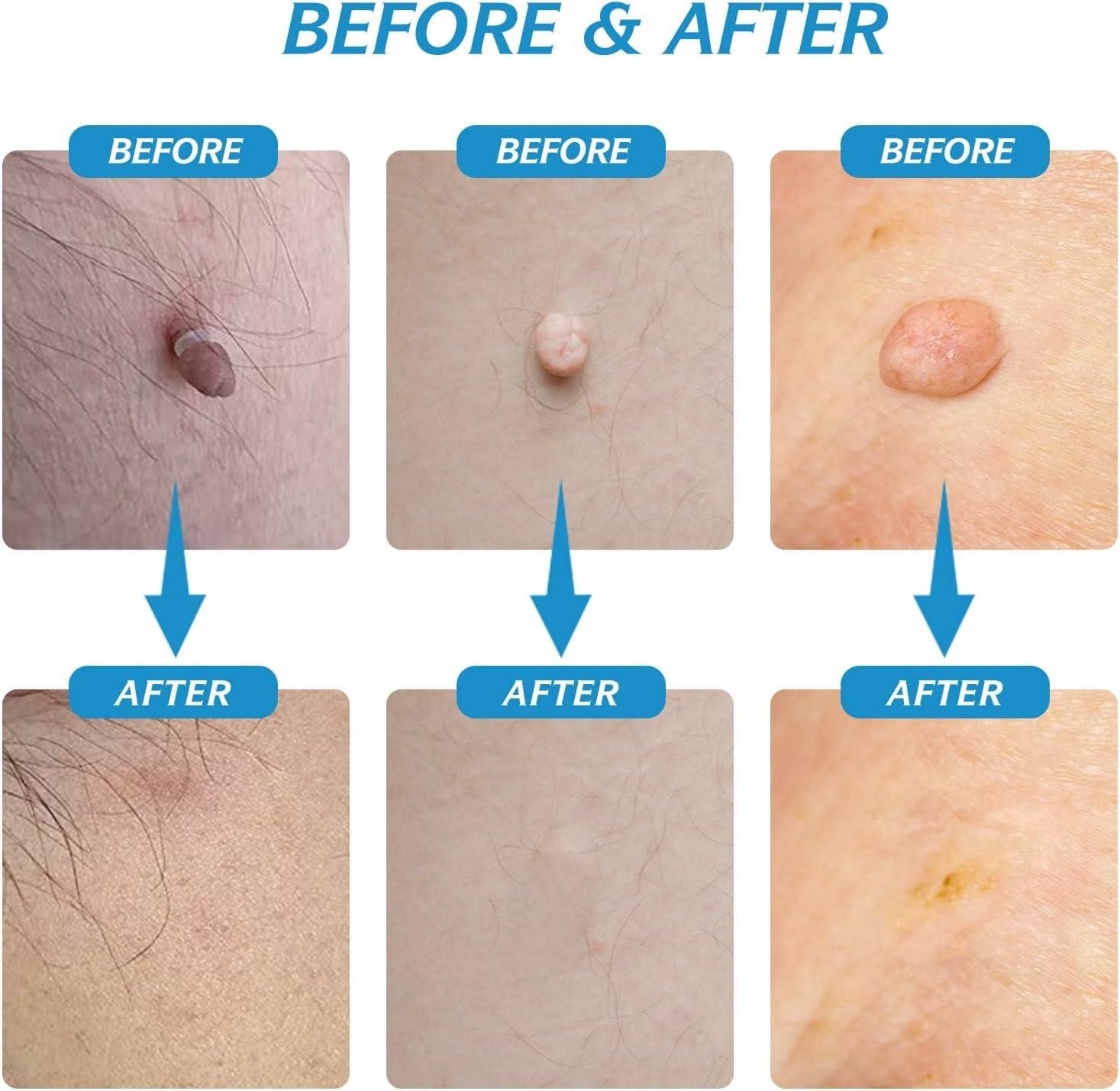 Before and after images showing effective skin tag removal using 2 in 1 Skin Tag Remover Kit painless treatment.